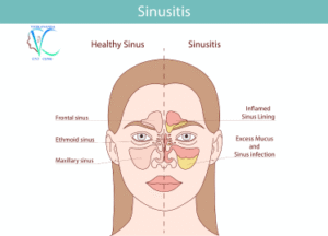 Sinusitis Symptoms and Treatment in Kolkata